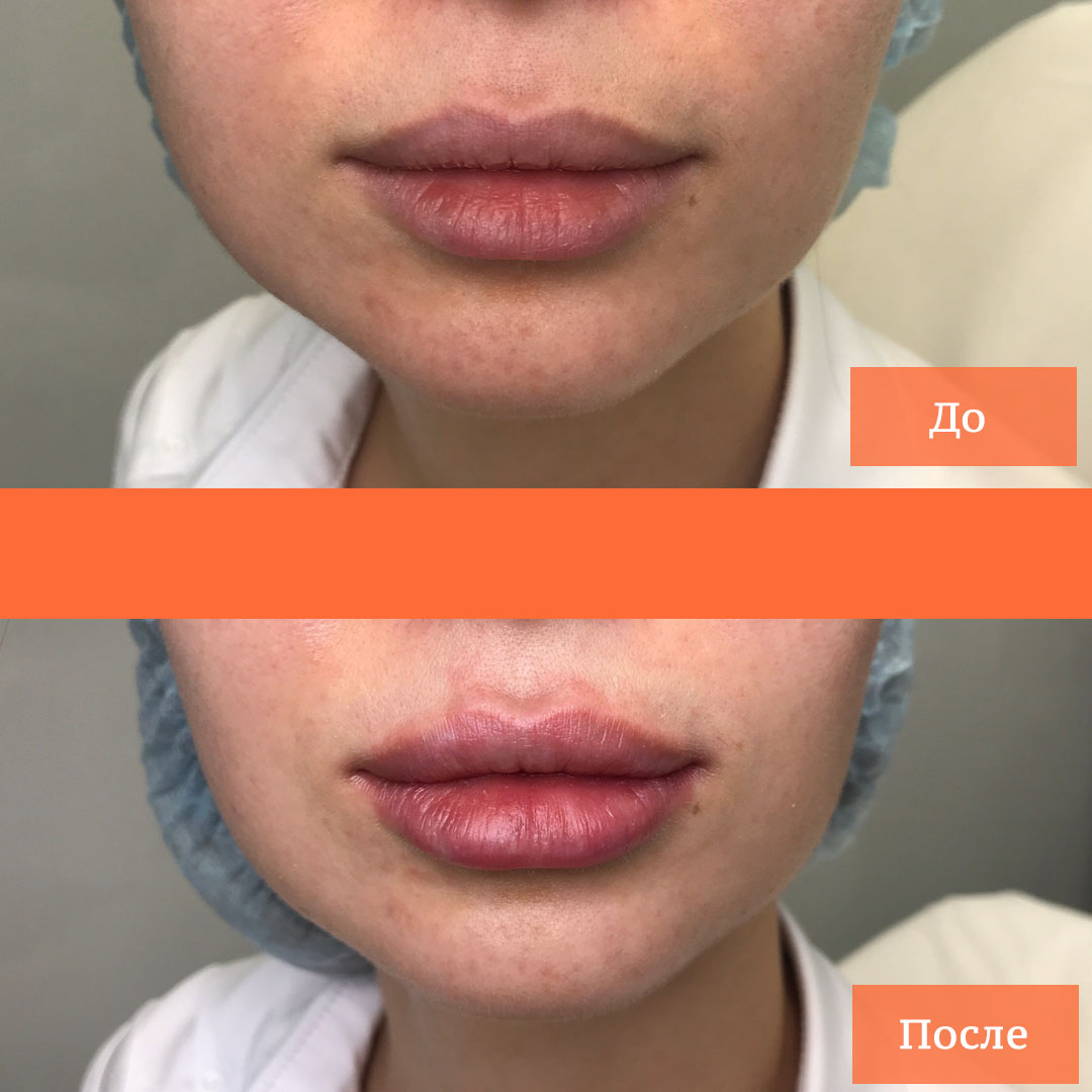 Как выглядят губы после процедуры?